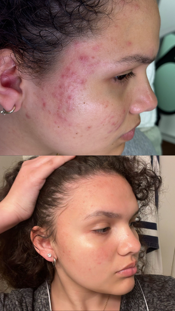 Acne treatment