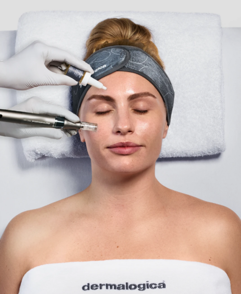 Microneedling With Exosomes