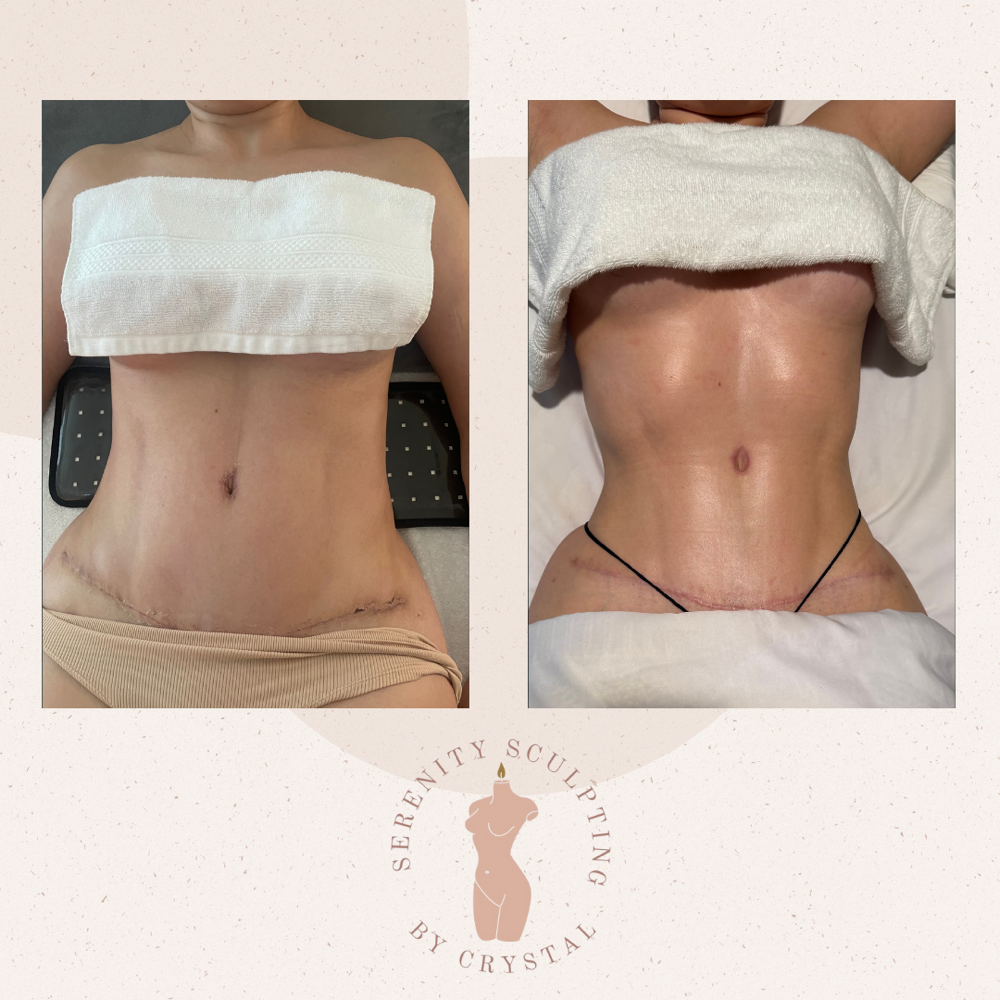 Post-Op Drain at Serenity Sculpting in Madera, CA