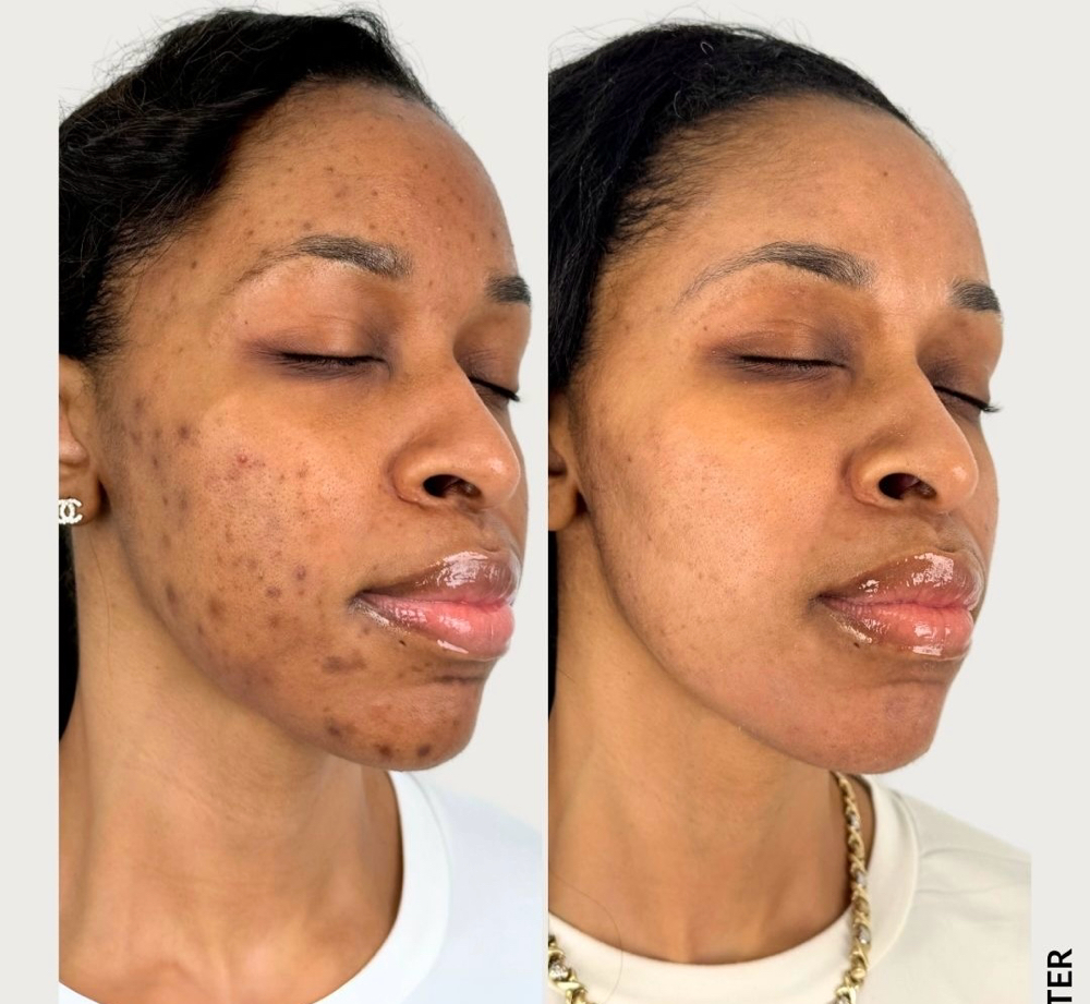 Luminance Brightening Chemical Peel at The Twisted Angel Salon & Spa in Bloomington, IN