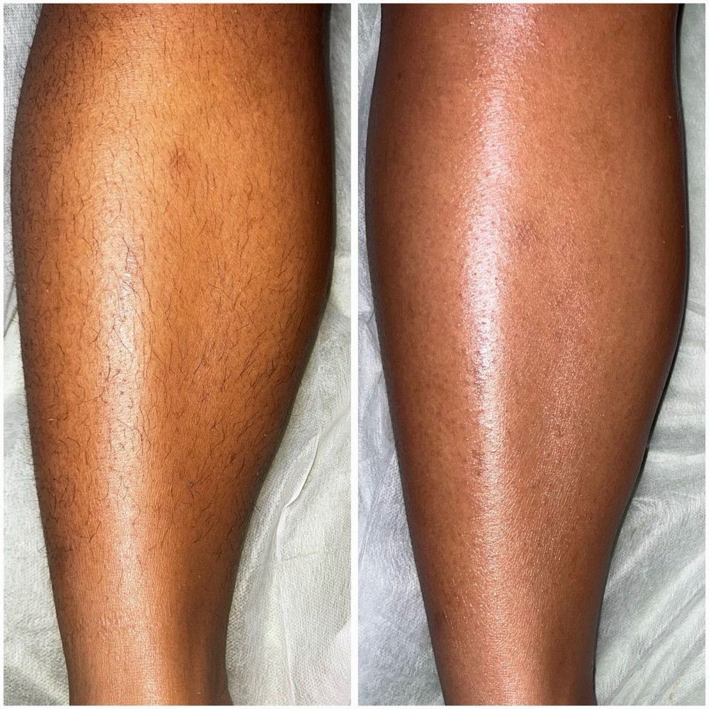 Full Leg at Esoteric Esthetics in Pecos, TX