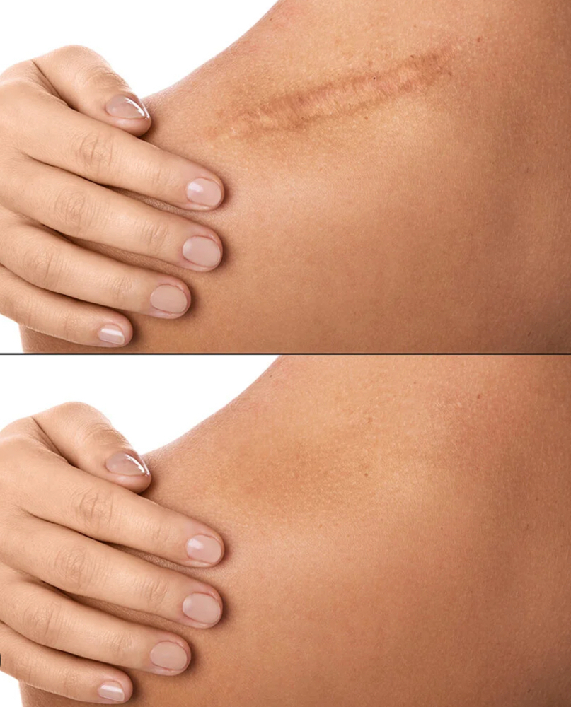 Stretch Marks or Scars 4 Sessions ( 1 Area)