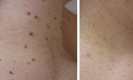 Skin Tag Removal