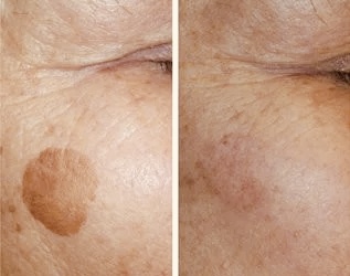Age Spot Removal