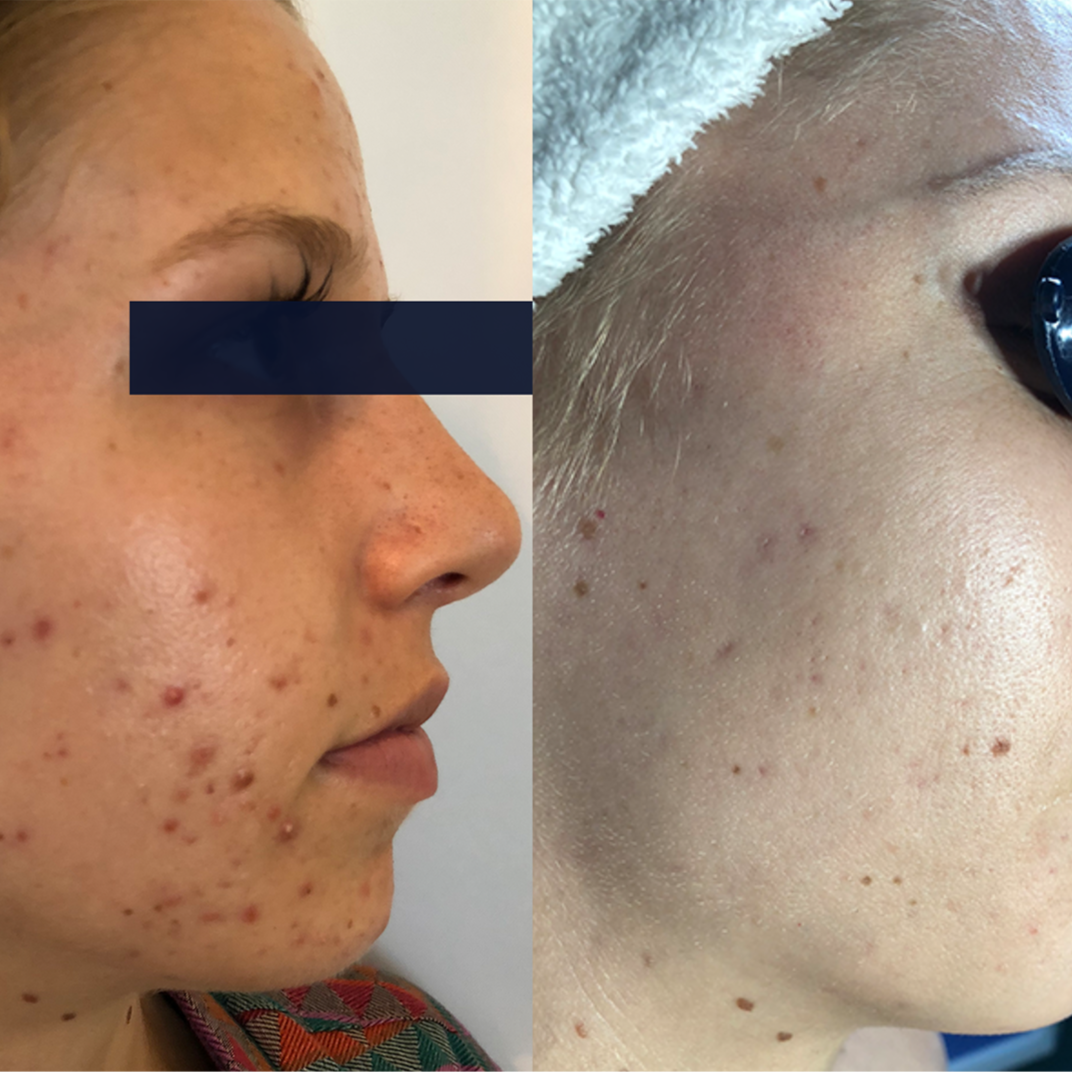 Skin Reboot at Ingrid Thompson Skincare in Beverly Hills, CA