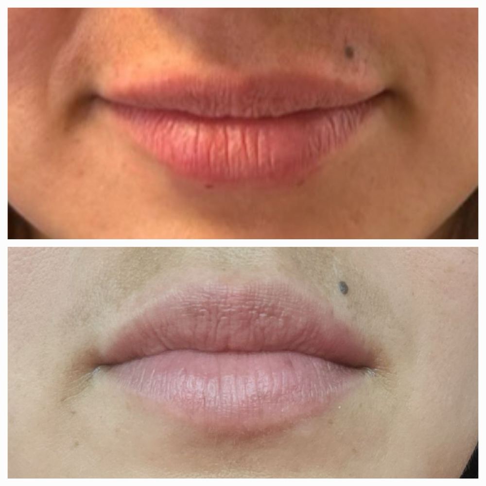 The Lip Flip