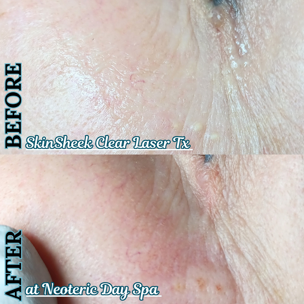 SkinSheek Clear Laser Treatment