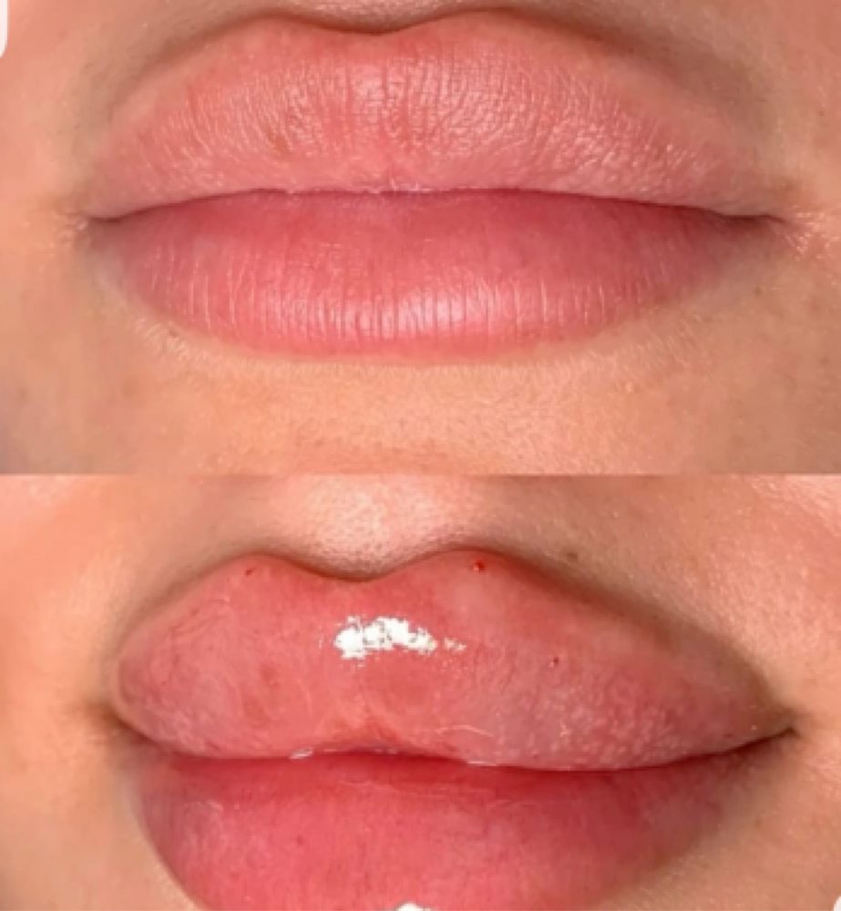 Juvederm at AIKO AESTHETICS in Melrose Park, IL