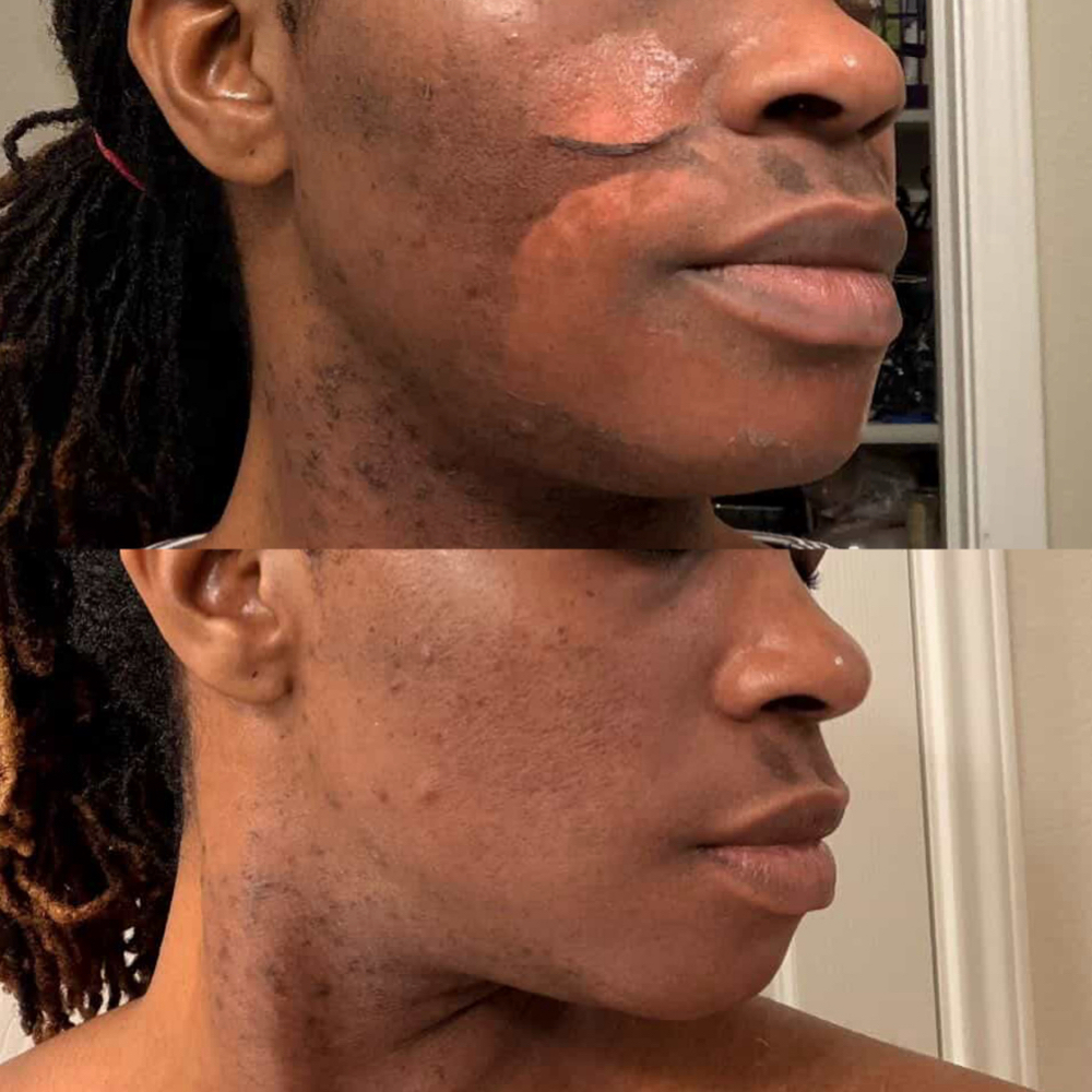 Perfect Derma™ Peel at Atelier Aesthetics and Infusions in Dallas, TX