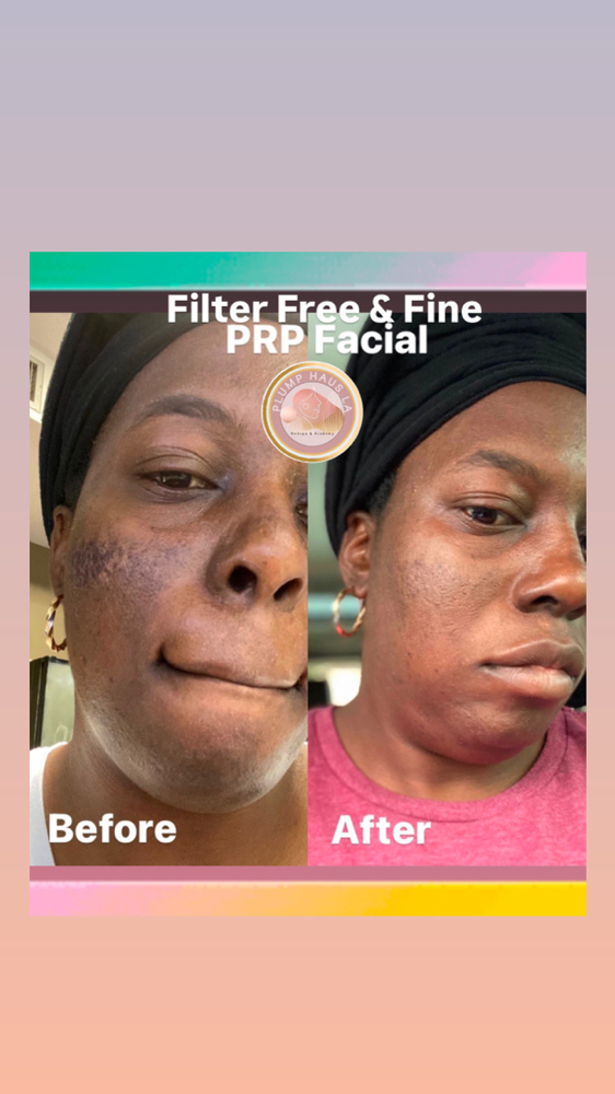 Filter Free & Fine Vampire Facial
