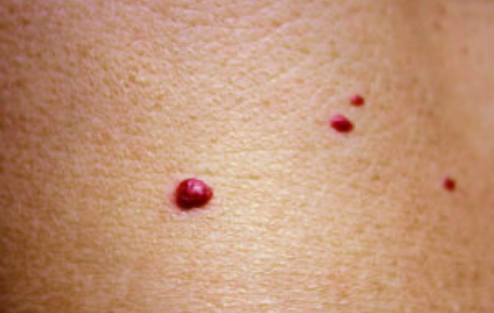 Cherry angioma