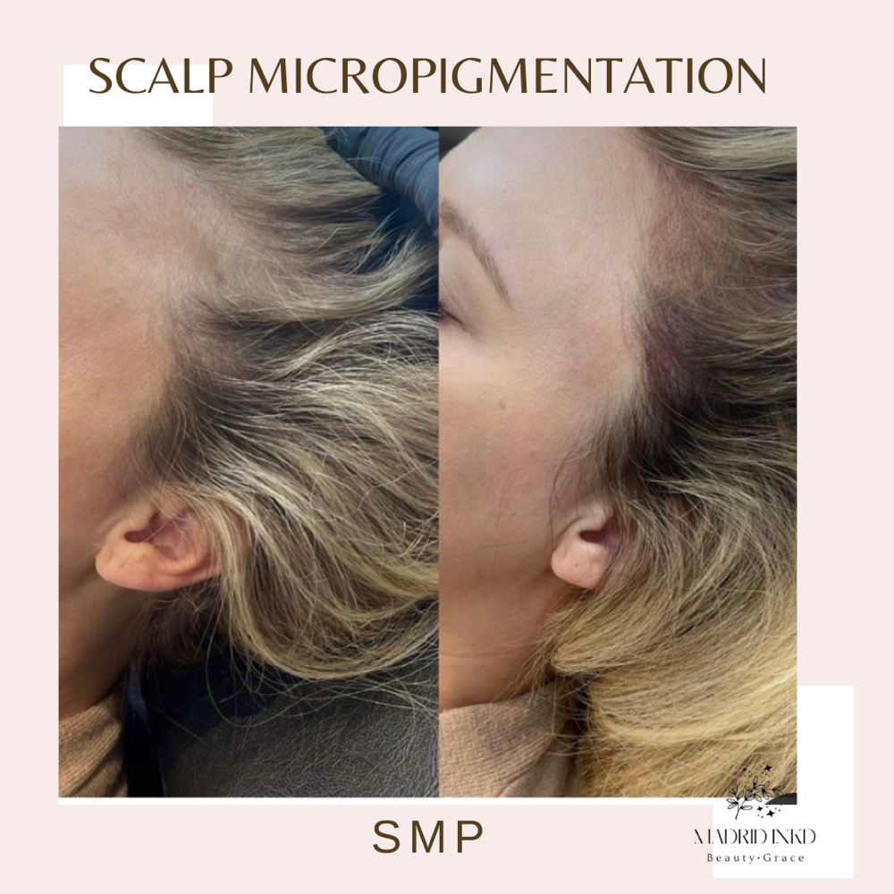 Scalp Micropigmentation Female