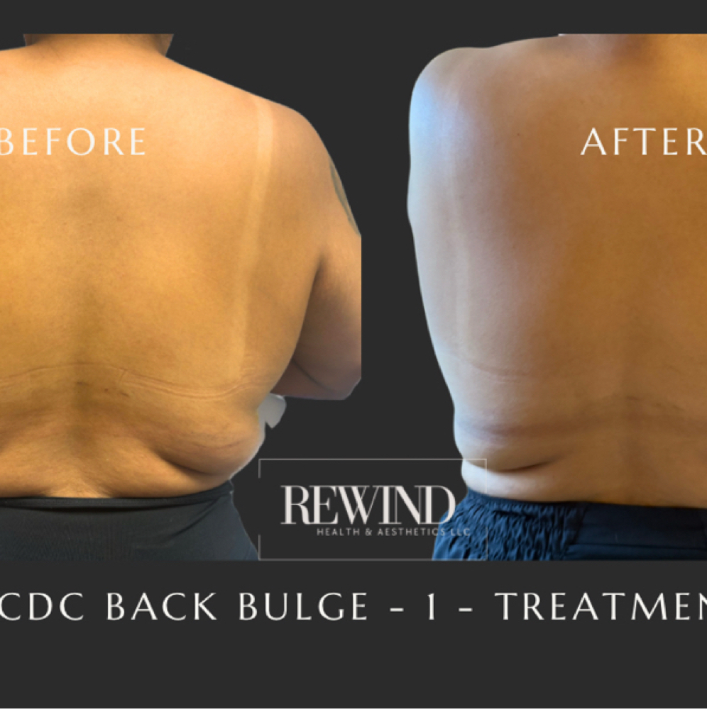 Back Fat PCDC đź’‰ at Rewind Health & Aesthetics LLC in San Marcos, TX