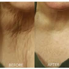 Chest collagen Induction