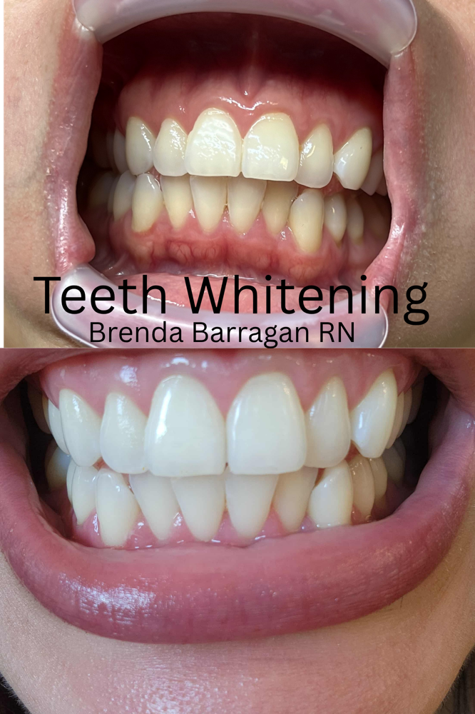 Teeth Whitening at AllyouneedlexBB in Grand Praire, TX