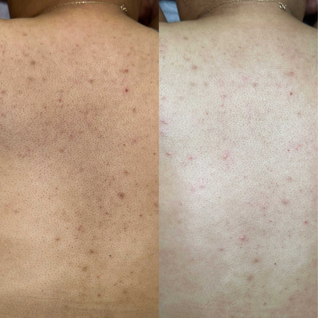 Essential Back Facial