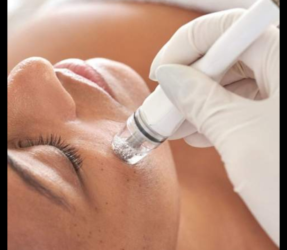 Microdermabrasion Facial