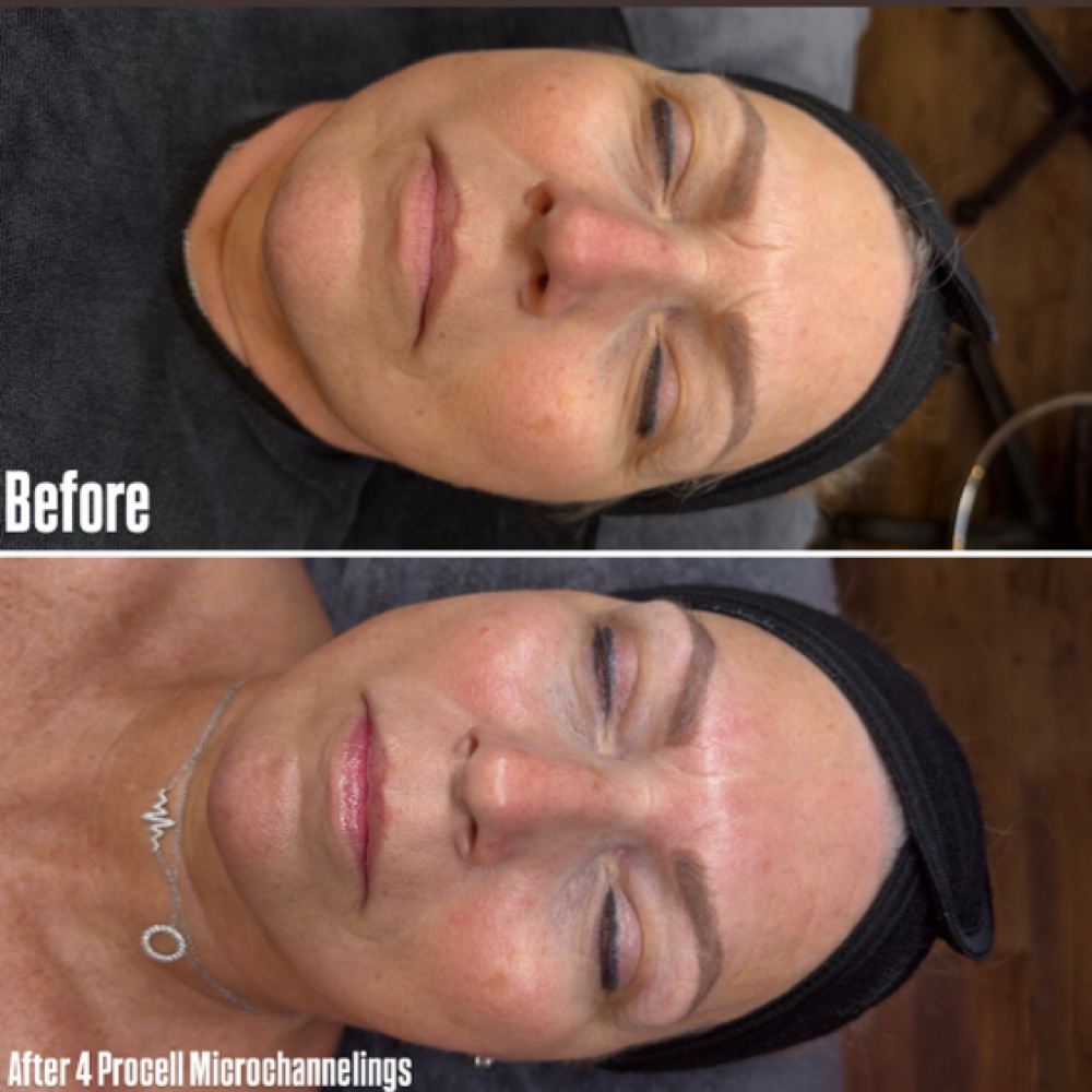 Procell Microchannelling Face/Neck at Sam Elam Esthetics in Meridian, ID
