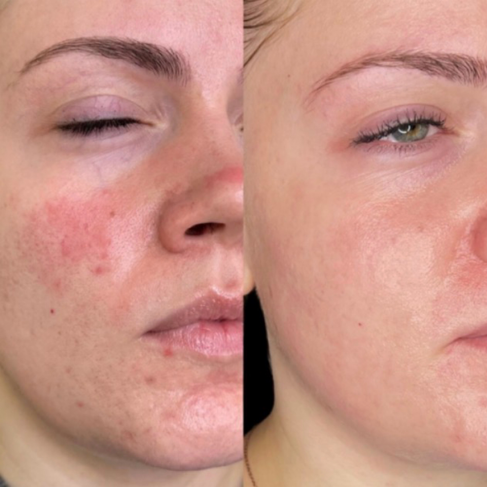 Acne Treatment at Lumeva Aesthetic L.L.C in Maryland, MD