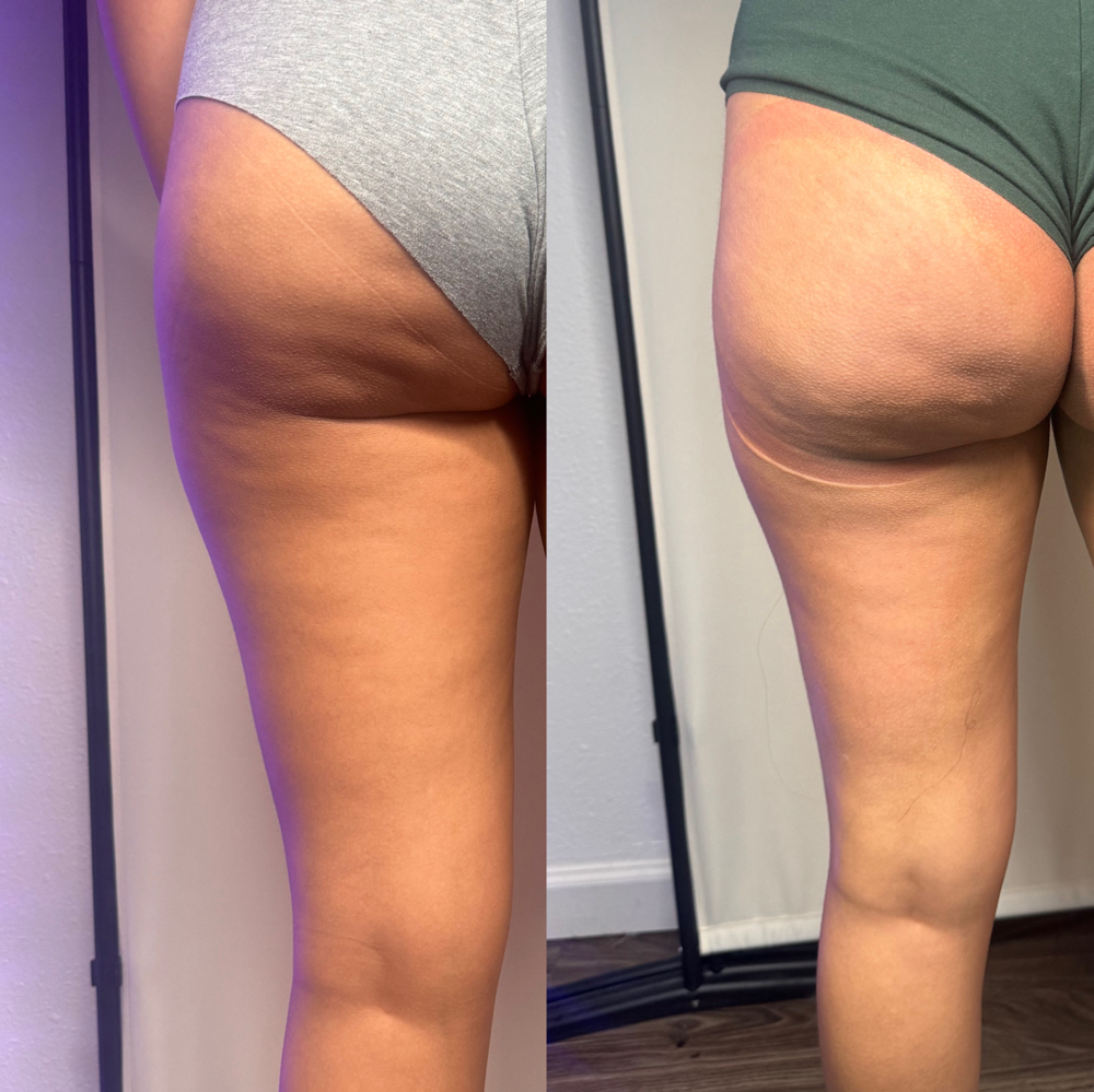 Cellulite Removal
