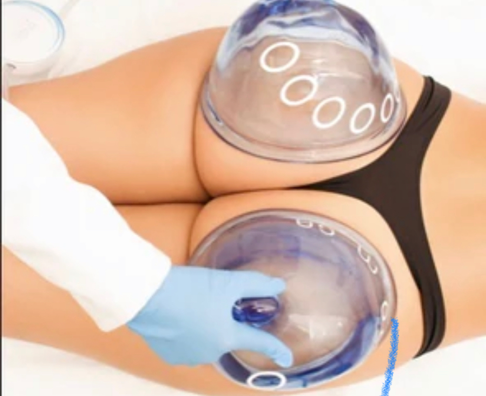 Non Invasive Brazilian Butt Lift