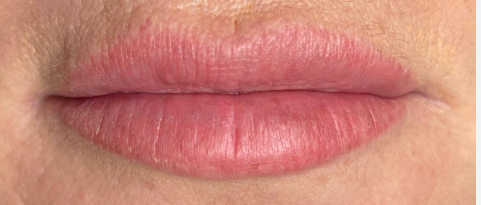 Lip Pigmentation