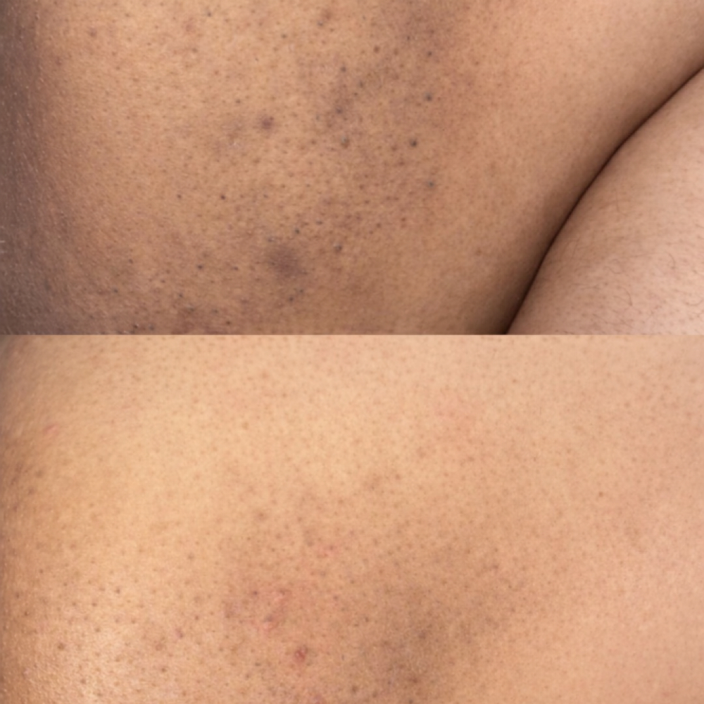 Inner Thighs Skin Lightning at The beauty spot in Montclair, CA