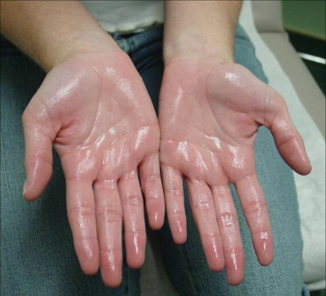 Hyperhydrosis Tox in Hands or Feet