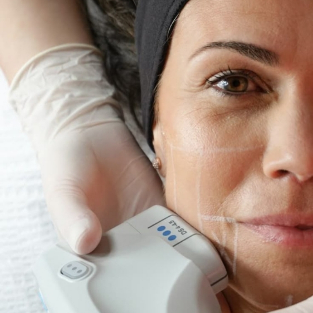 Ultraformer HIFU MPT at Halo Aesthetics Center in Harrison, NJ