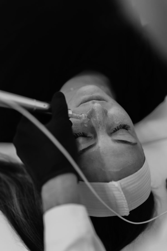 Microneedling with Lactic Acid