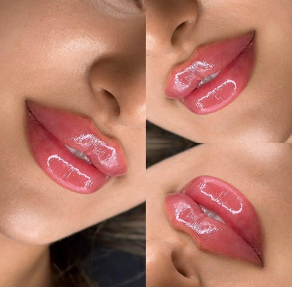 Lip/Chin/Cheek Filler at Beautified Studios in San Antonio, TX
