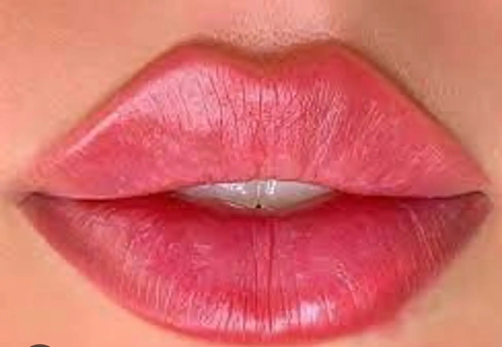 Lip/Chin/Cheek Filler