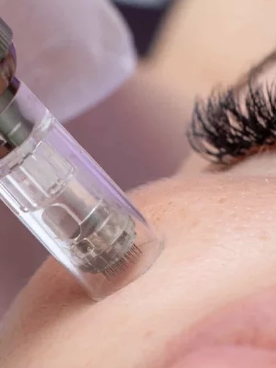 3 Microneedling Tx