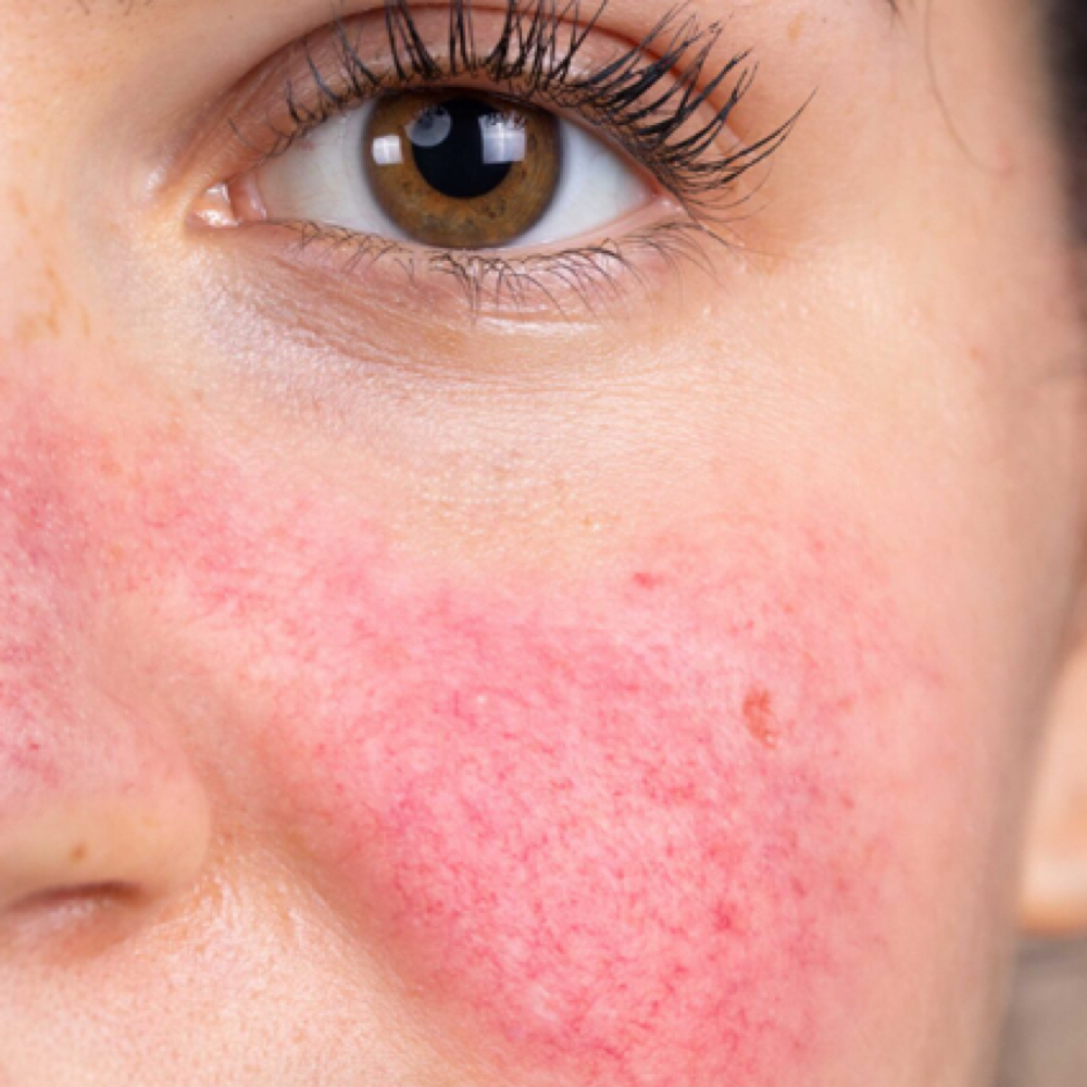 Rosacea Face treatment at PRYSM LIGHT in West Burlington, IA