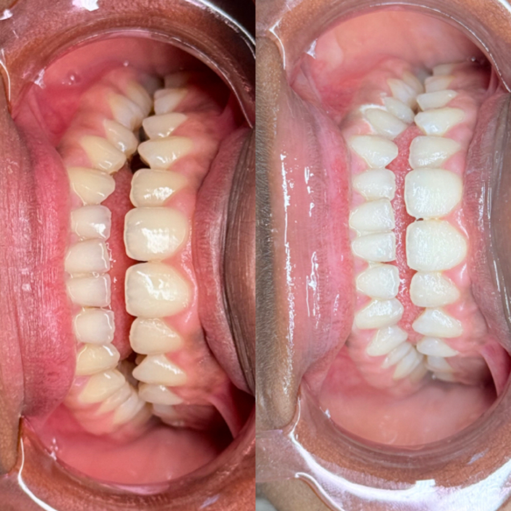 1 Hour Teeth Whitening Session at Elysian Beauty in Chicago, IL