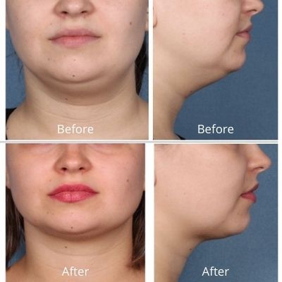 Fat Dissolve For double Chin