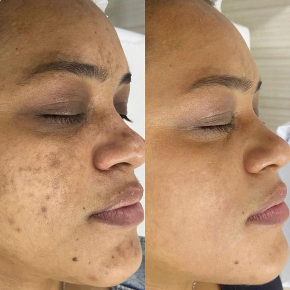 Acne Facial