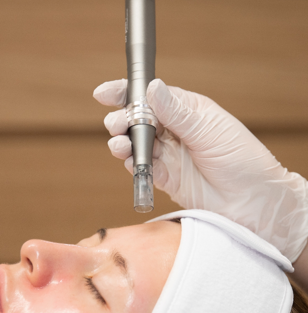 Microneedling