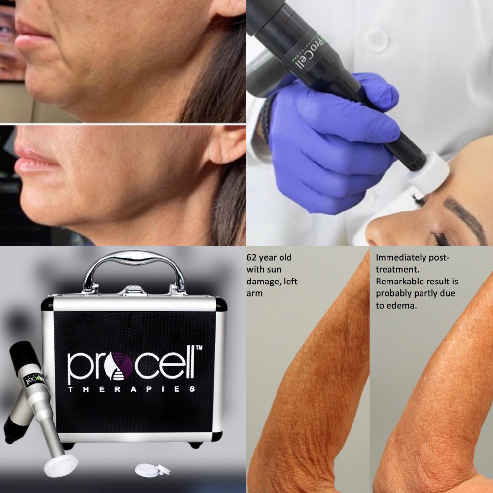 StemCell & Collagen Induction Lift