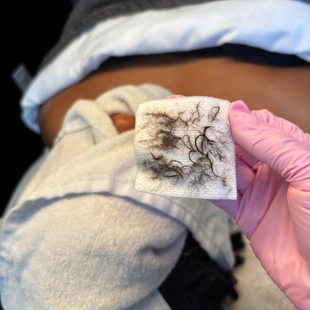 Dermaplaning Skin Glow Facial at Lins Esthetics in Gaithersburg, MD