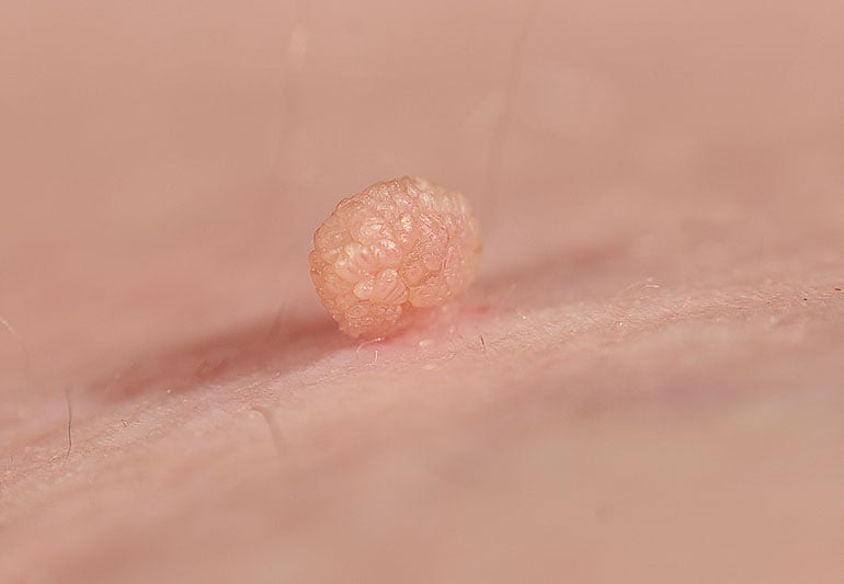 Skin Tag Treatment