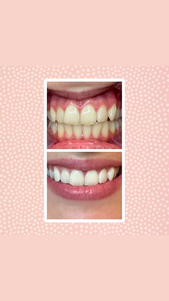 3 Month Teeth Whitening Refresh