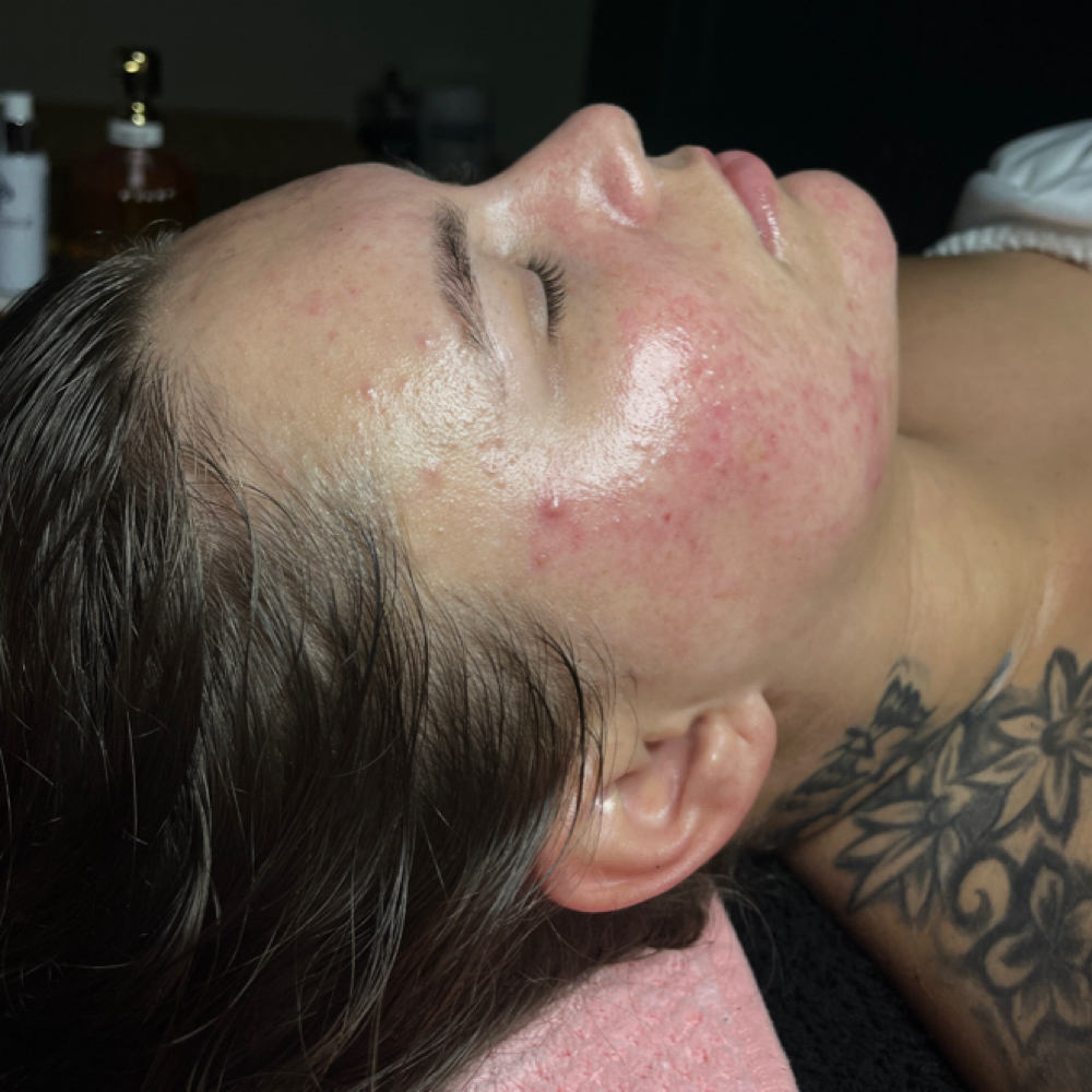 Acne facial at Bae's Beauty Esthetics in Milan, TN