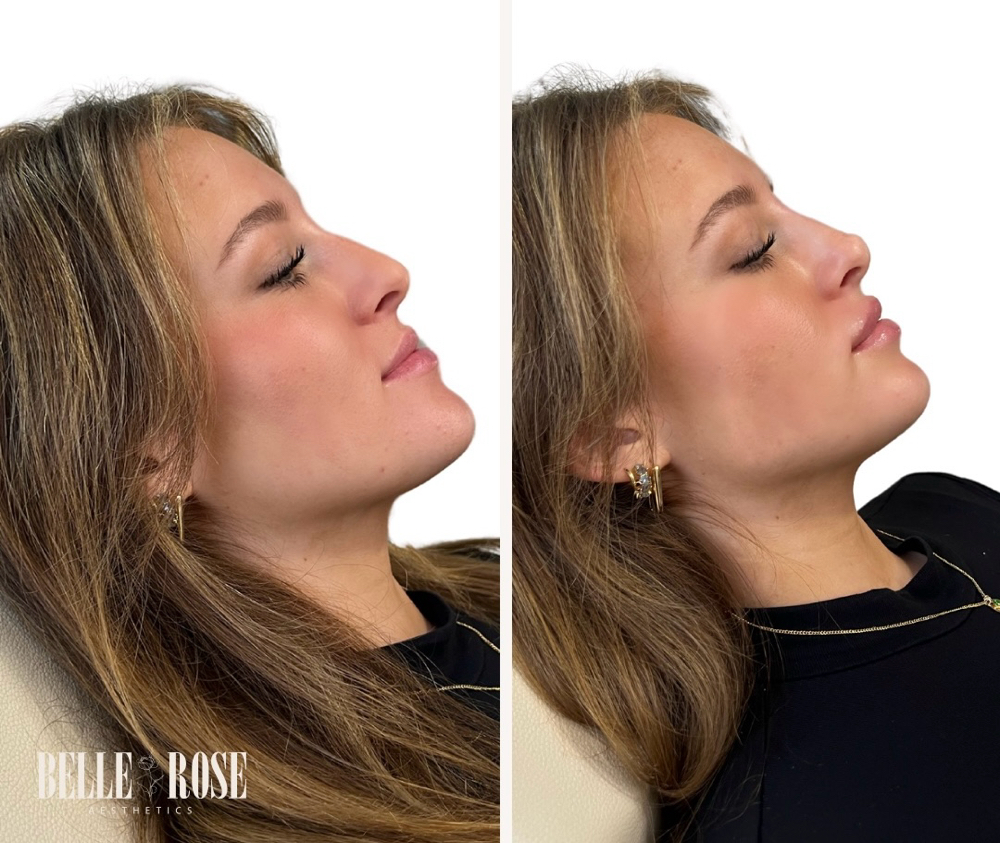 Liquid Rhinoplasty