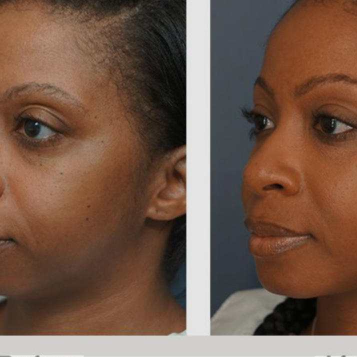 4 Facial slimming/tightening at Glo'Up Body Spa in Atlanta, GA