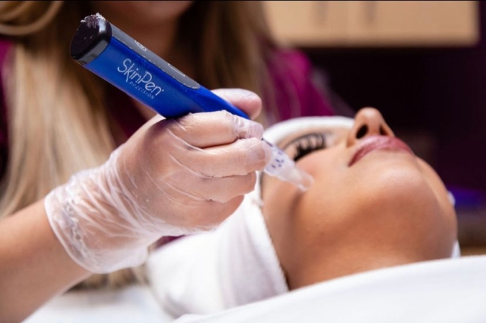 Micro needling Face/Neck (1)