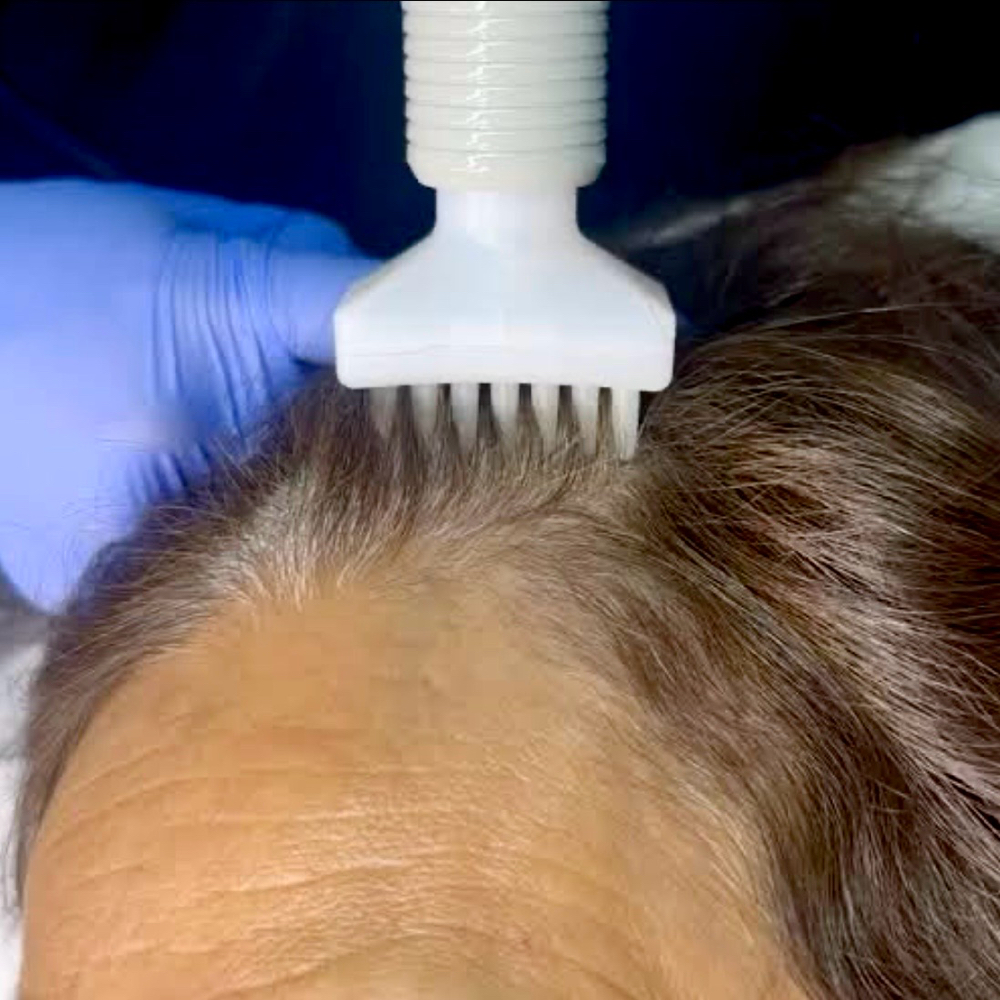 Coming Soon - Root Cold Plasma