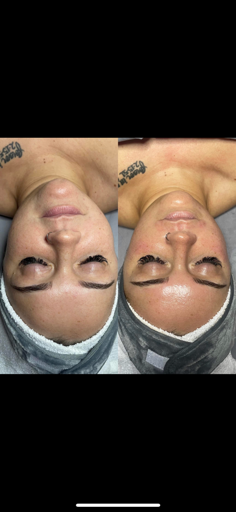 Dermaplane Facial