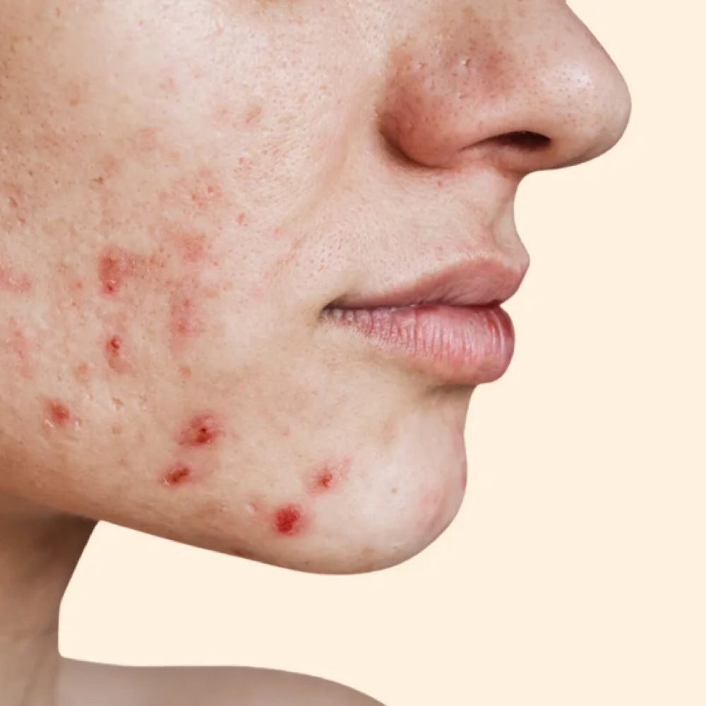 MB ACNE CONTROL PROTOCOL™ at MB BEAUTY CLINIC | AESTHETICS | PMU in Nantucket, MA