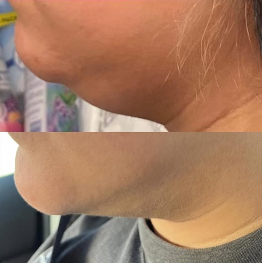 2 Sessions | Fat Dissolving